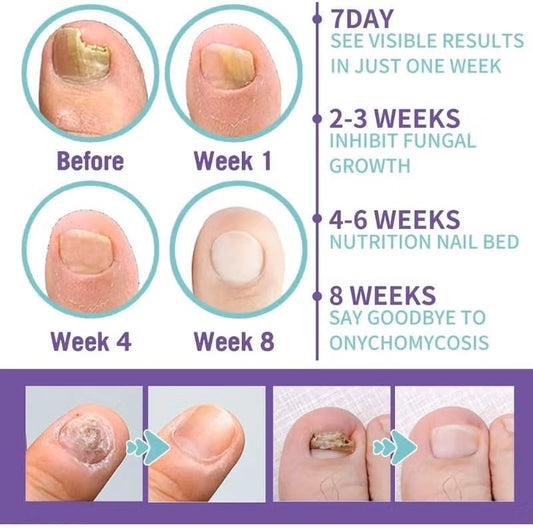 Nail Fungus Spray 100ml