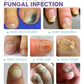 Nail Fungus Spray 100ml