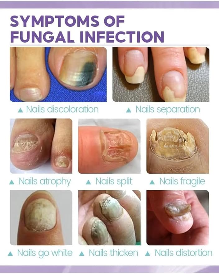 Nail Fungus Spray 100ml